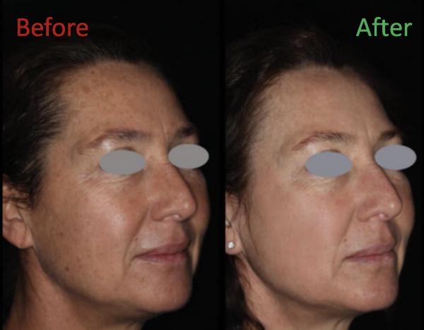 [Thumb - photofractional laser before and after.png]