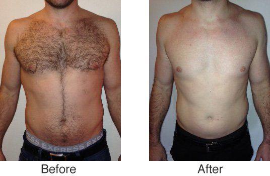 [Thumb - chest before after.jpg]